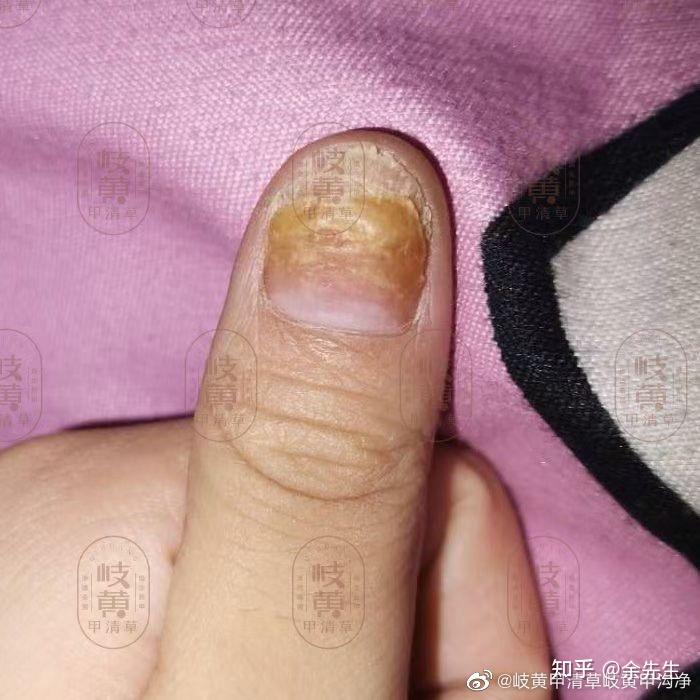 手大拇指指甲中有一块白了是什么原因? 