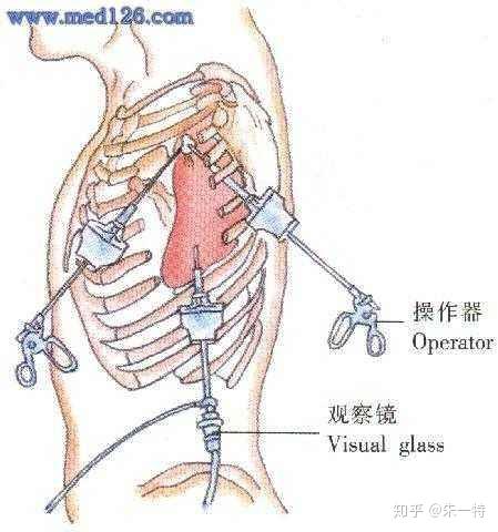 气胸穿刺点图片