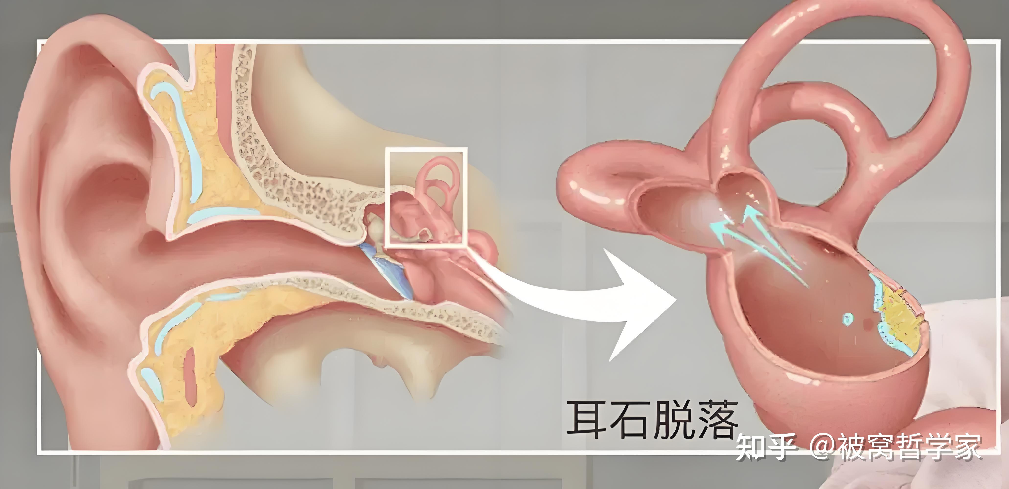 耳石症是什么原因引起的的?