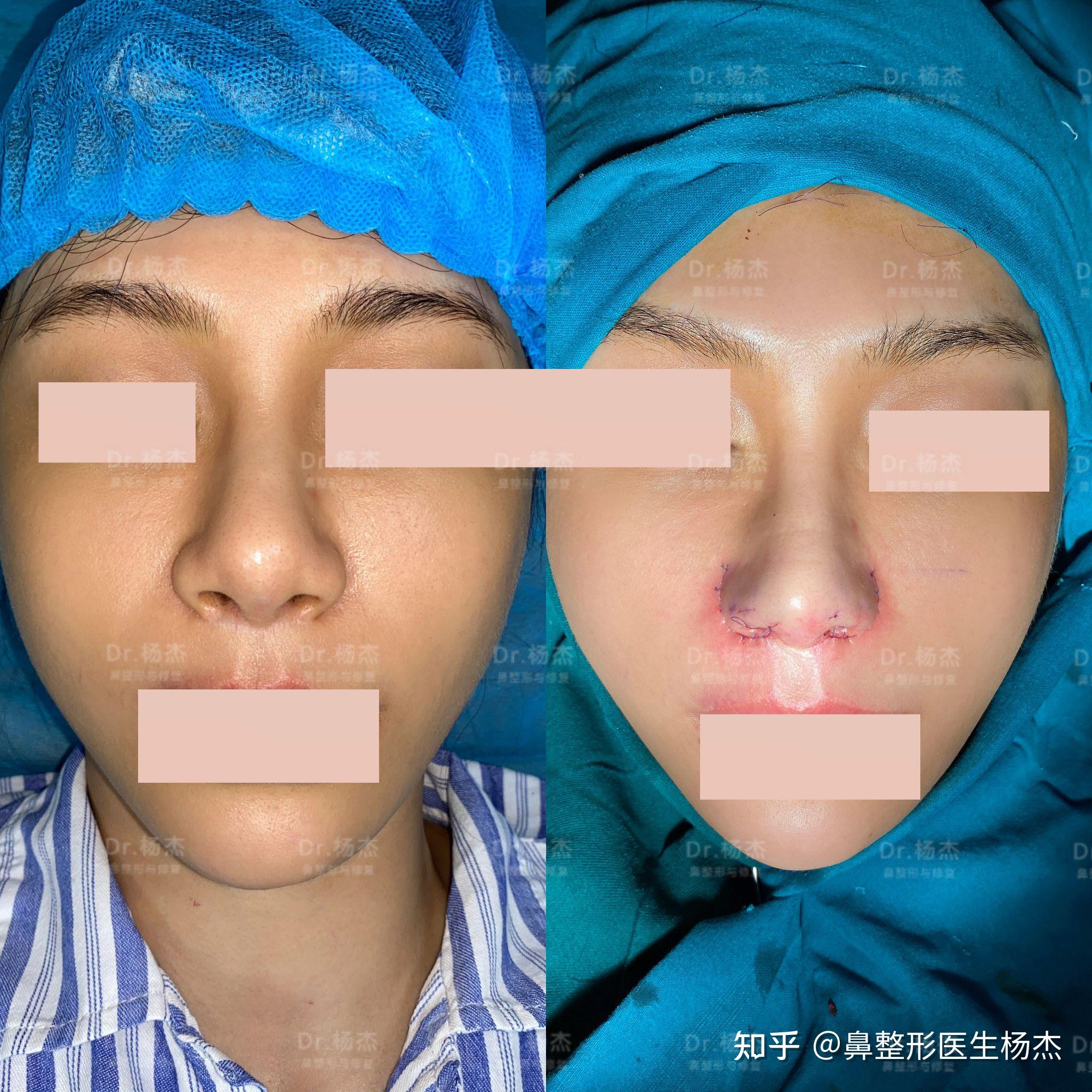 露鼻孔鼻翼缘退缩矫正修复