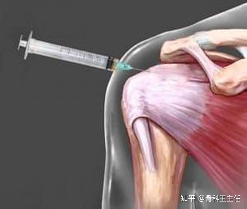 肩周炎关节腔注射疗法图片