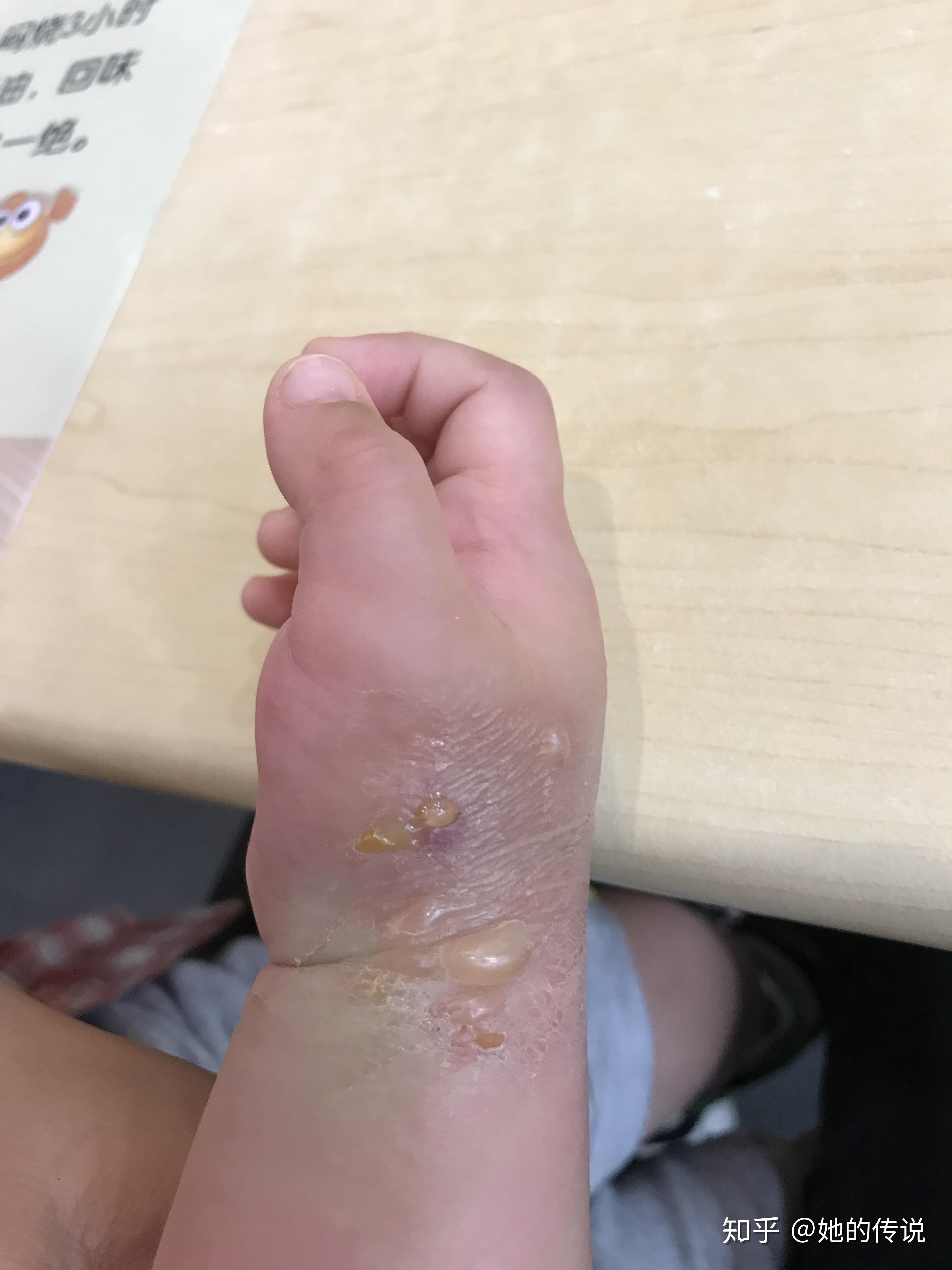 被隐翅虫咬了怎么治?让他自己好?还是要看医生?