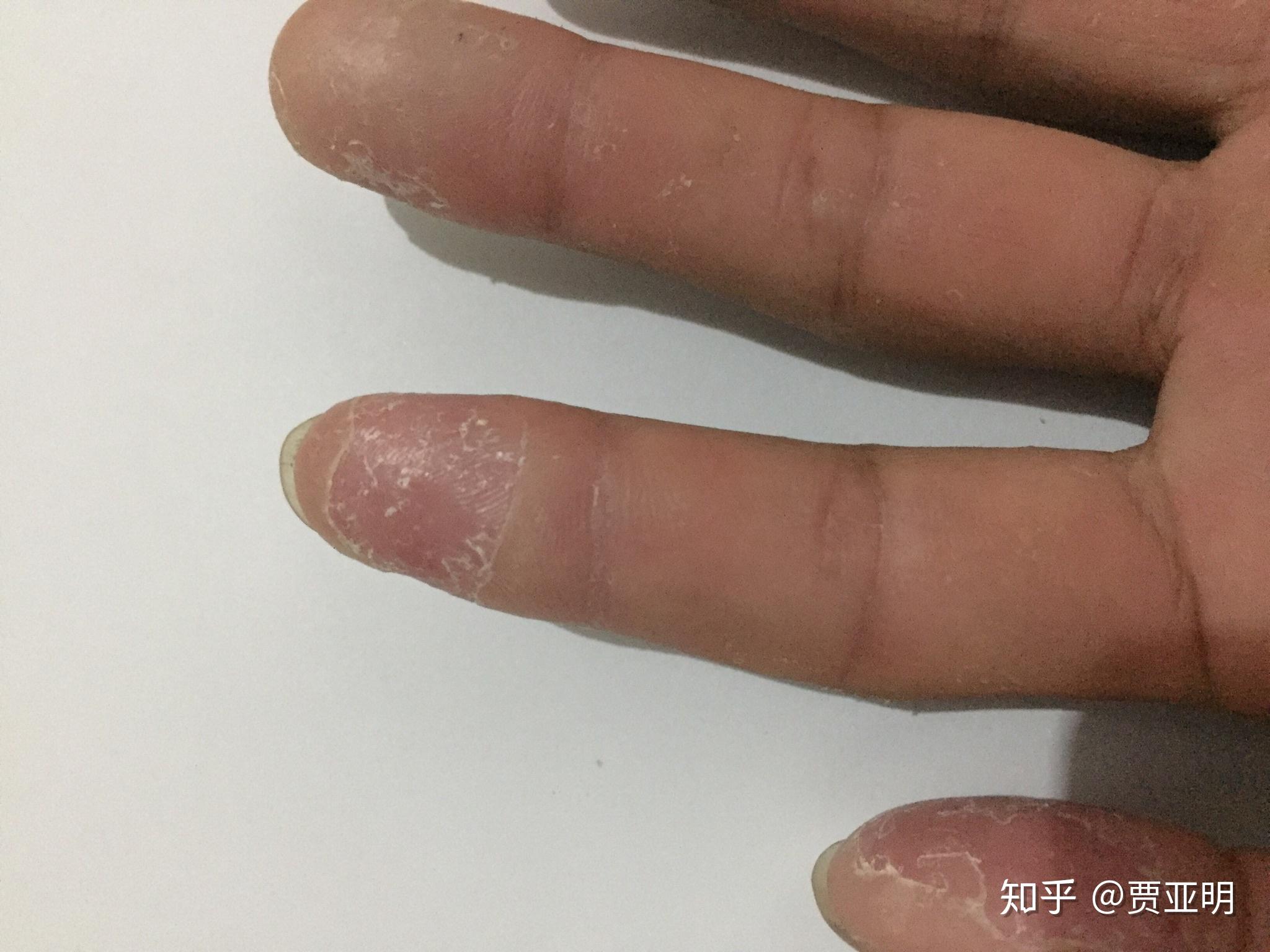 季節性手脫皮什麼原因有什麼方法可以根治嗎