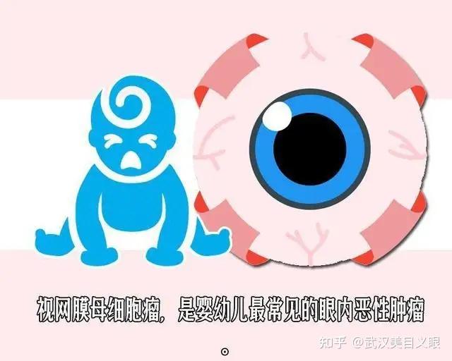 什么是视网膜母细胞瘤？ - 知乎