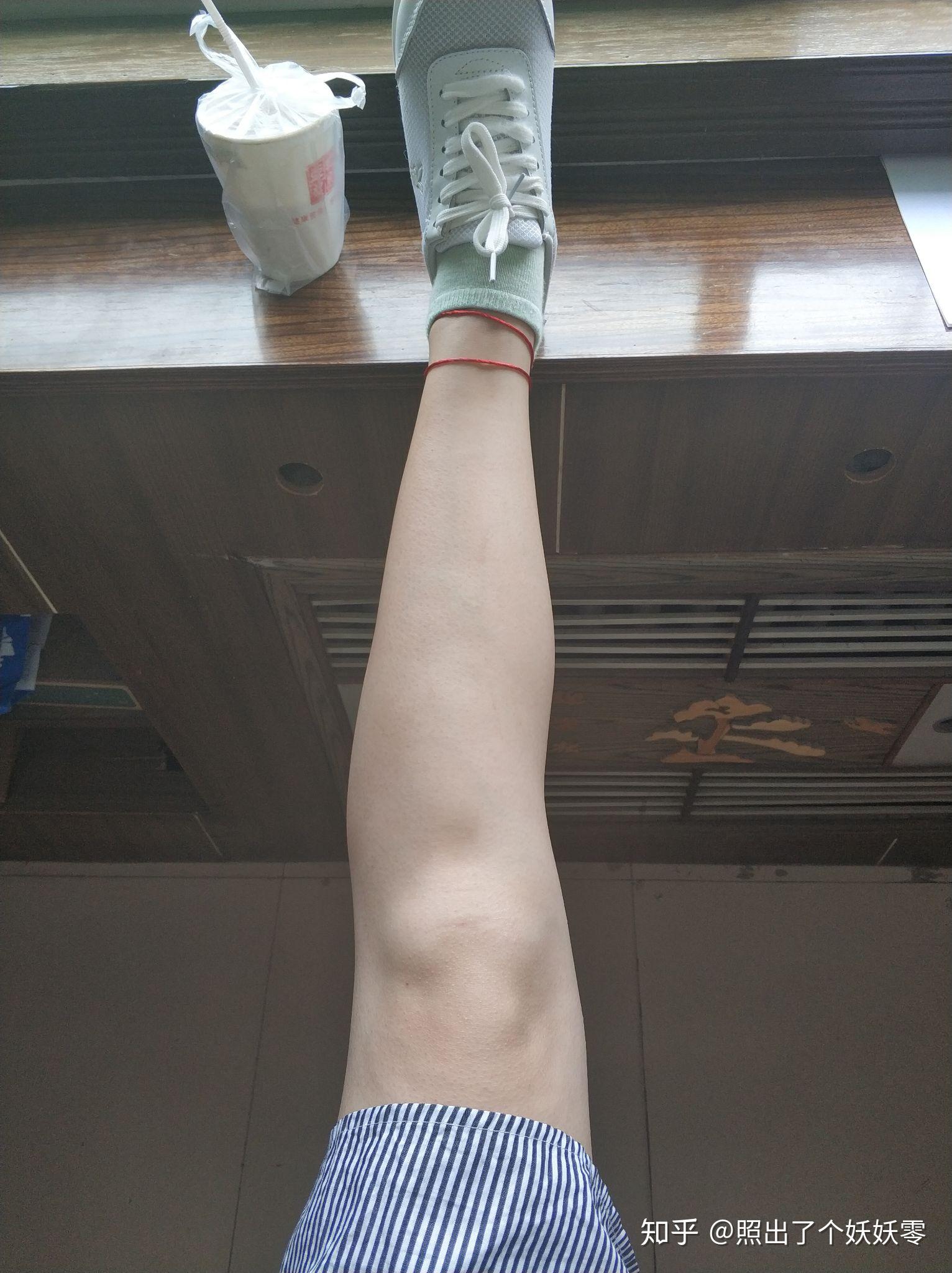 这个腿型是xo腿型还是腿不直该怎么改善呢