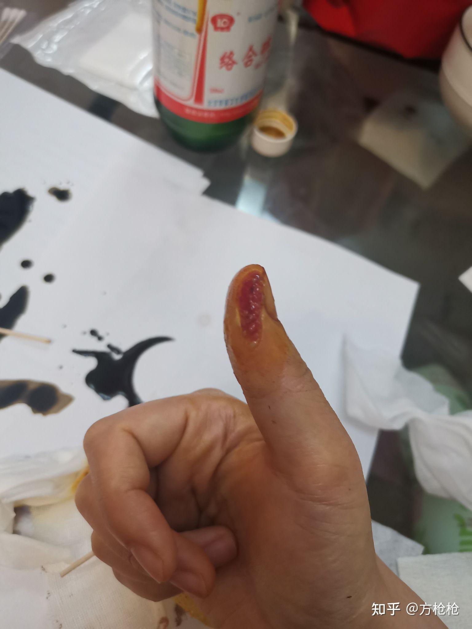 手指被切下一块肉,多长时间能恢复? - 知乎