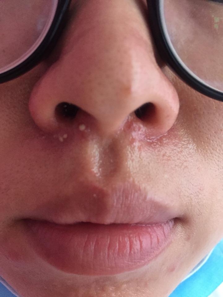 鼻子窝和嘴唇附近发红不停的起白色脓包