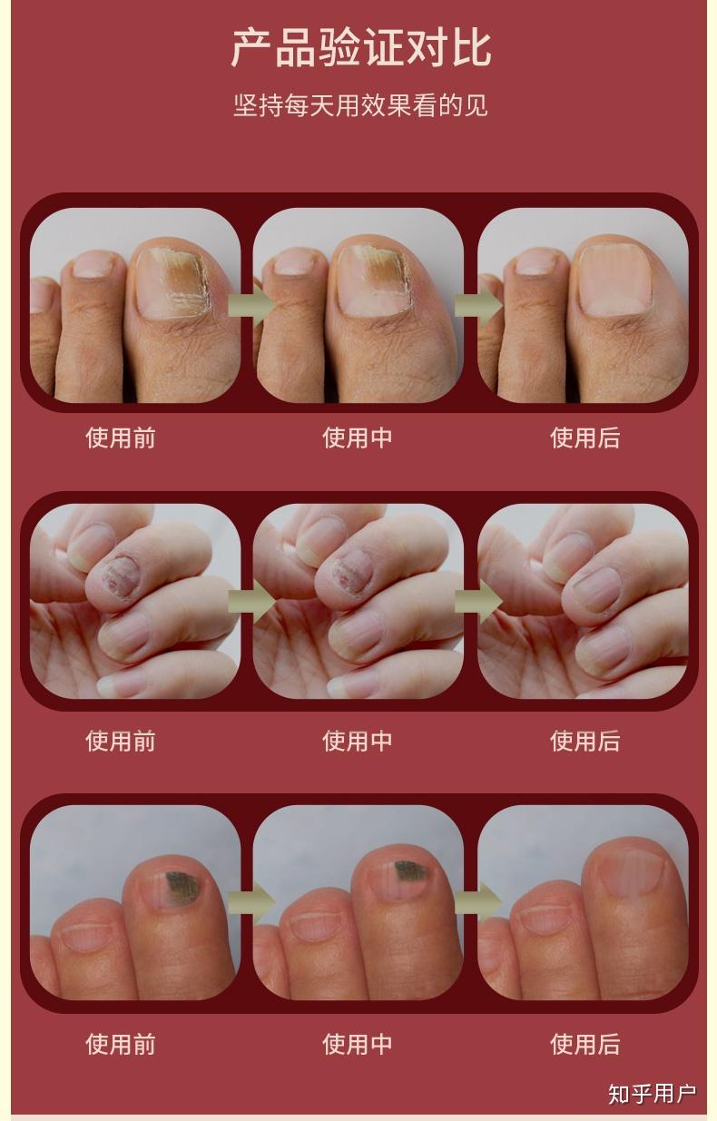 有人得过比较多的灰指甲成功治愈的吗? - 知乎