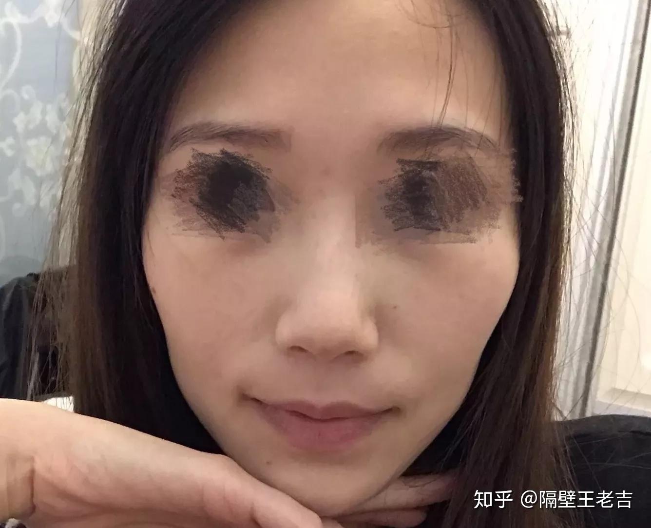 颧骨高脸颊凹陷微整形能纠正吗