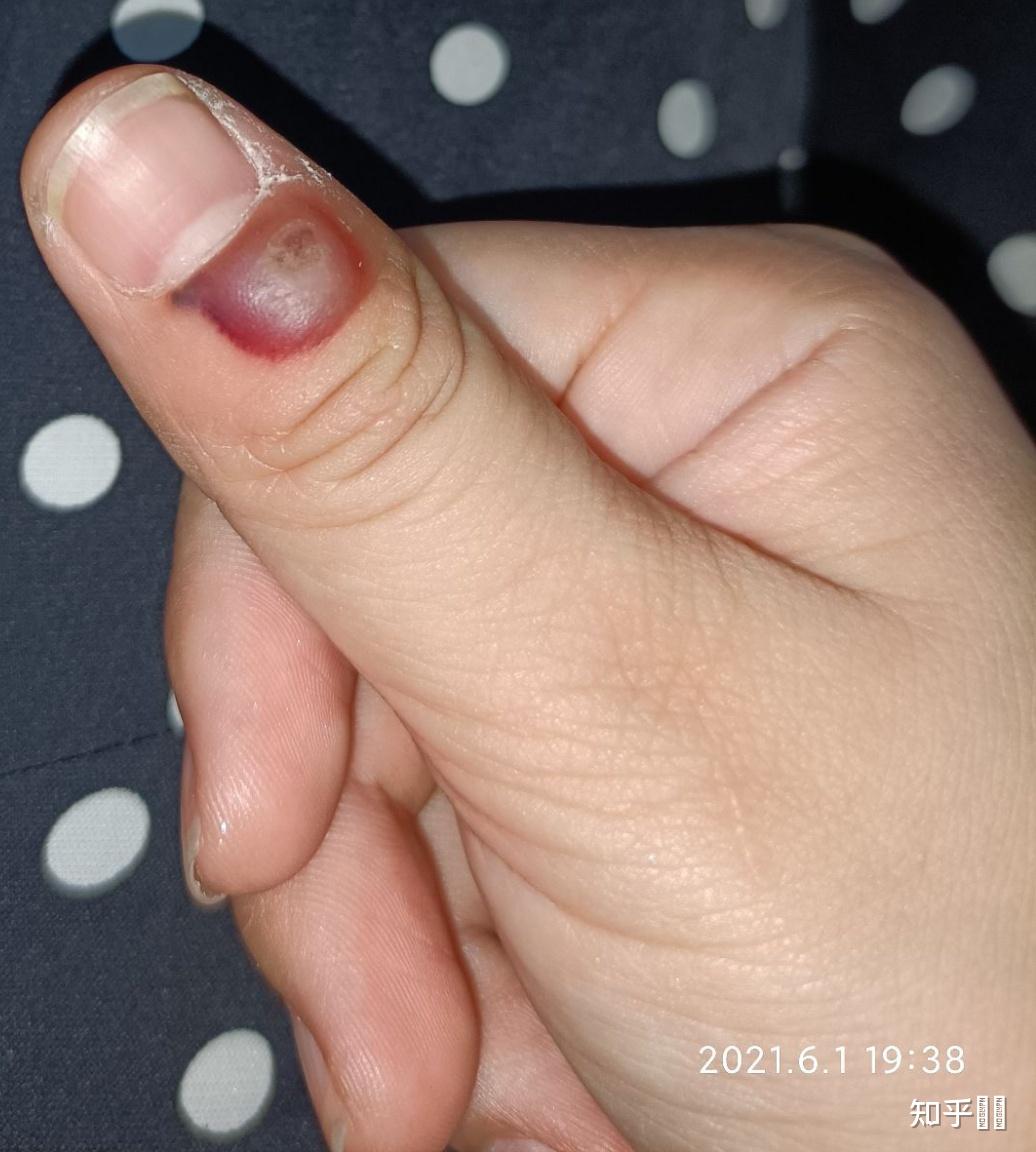 液氮冷冻治疗后手指上出了血泡而且越来越大该怎么办? - 知乎