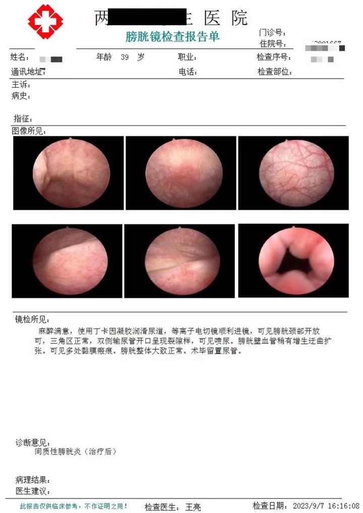 间质性膀胱炎治愈案例