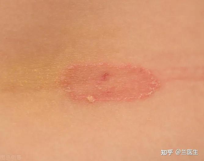 股藓留下的黑色素如何去除或者淡化？ 知乎 