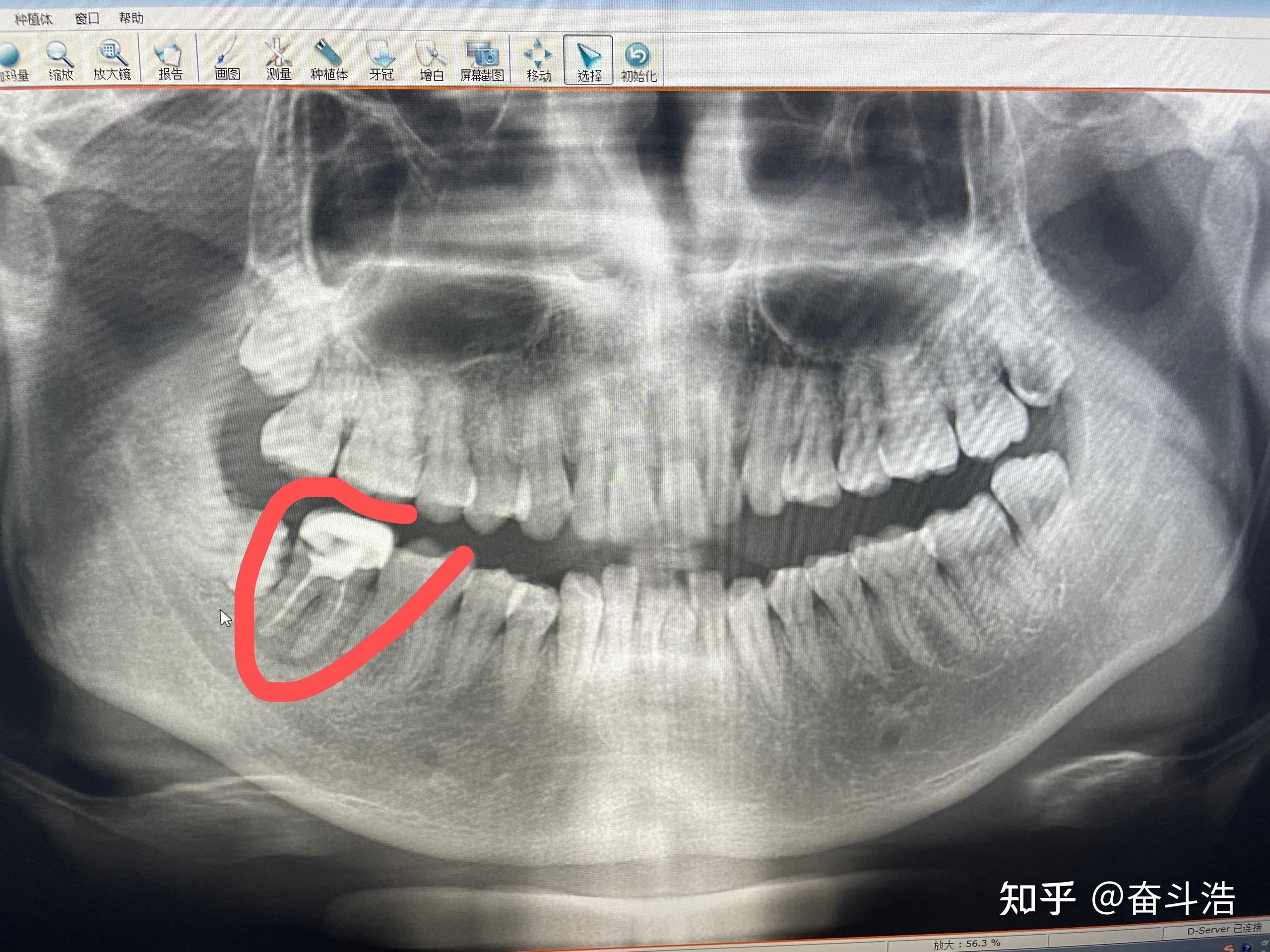 第一次根管治疗欠充已7年无不适排牙片阴影较大二次根管无法保证炎症