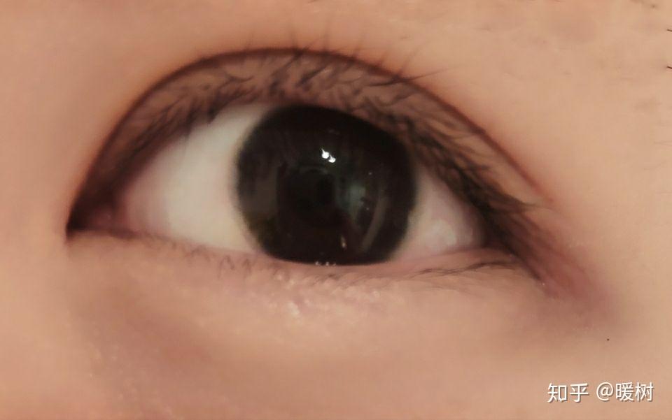 什么是双睫症身边有这样的朋友吗