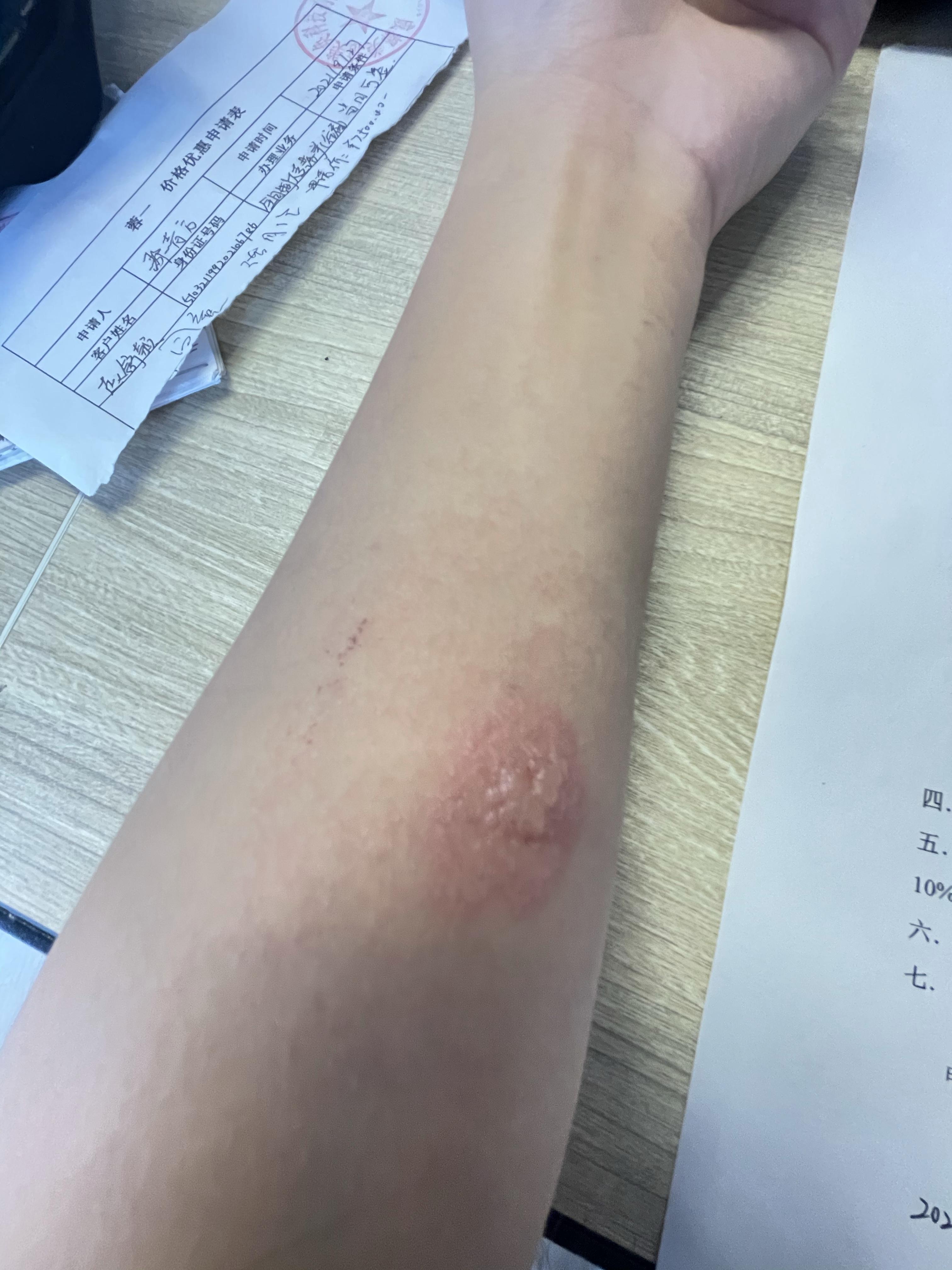 结核皮试起了个大水泡,破了怎么办? - 知乎