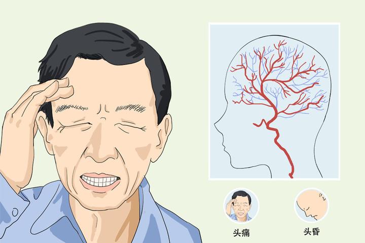 美尼爾氏綜合症手術多少錢