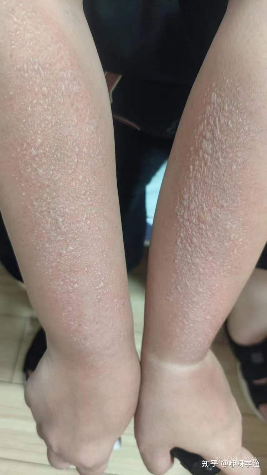 大夏天白天经常出去钓鱼,洗完澡手臂上就这样了,是什么情况?