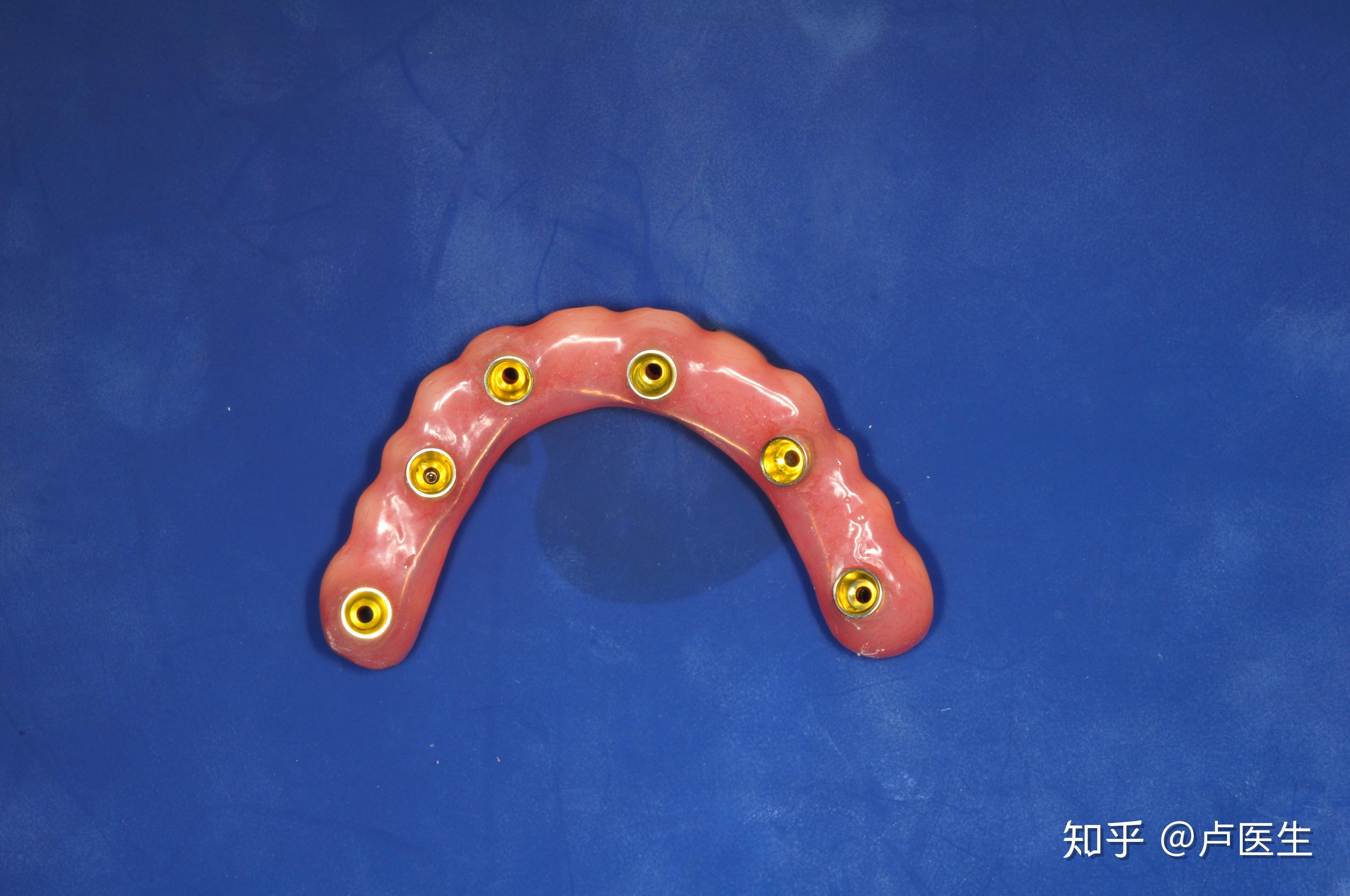 什么是allon4全口种植牙技术