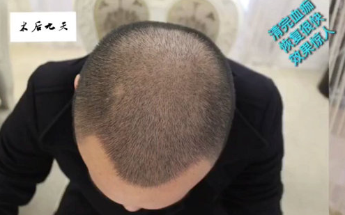 植发的密度是如何定义的密度是多少才合适