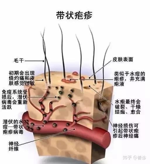 帶狀皰疹的誘因是什麼如何有效治療