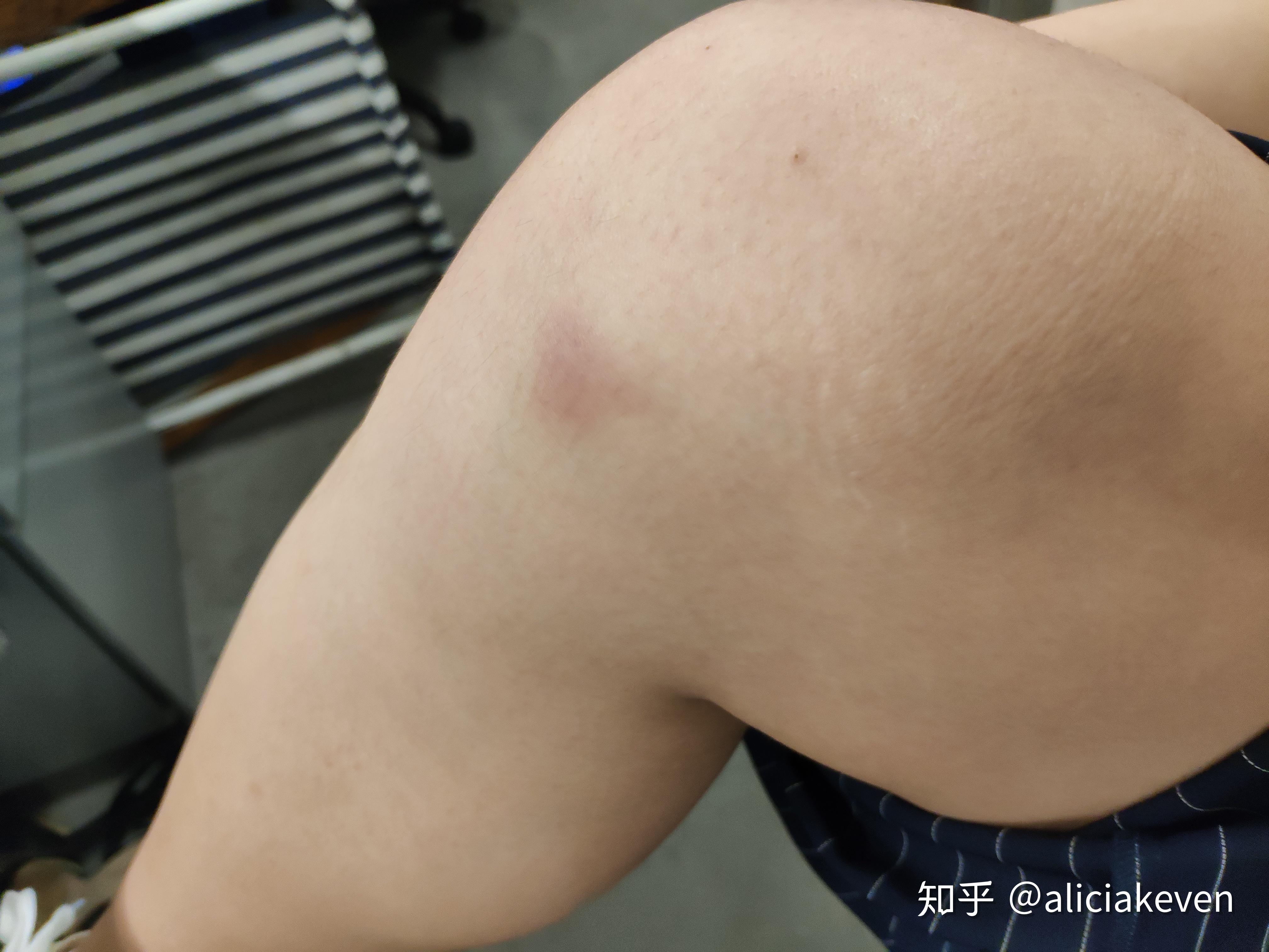 做完深蹲膝盖出现淤青是怎么回事? - 知乎