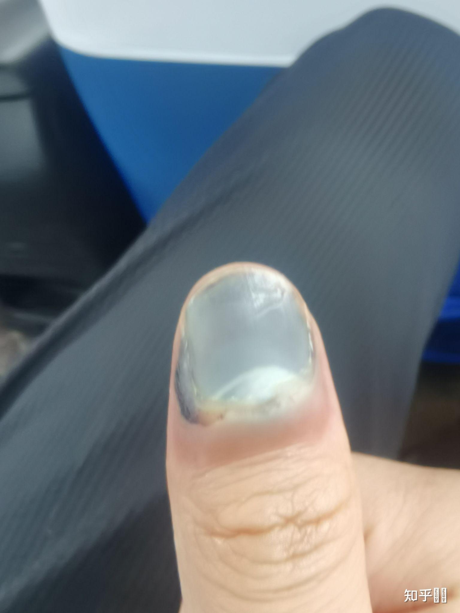 指甲被车门挤伤 指尖全是淤血 怎么办?