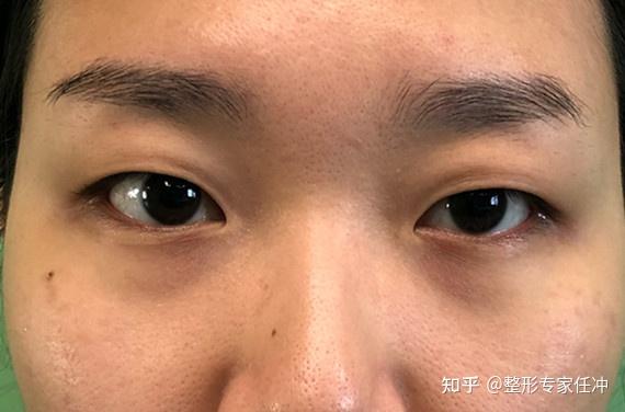我这是重度内眦赘皮吗? - 知乎
