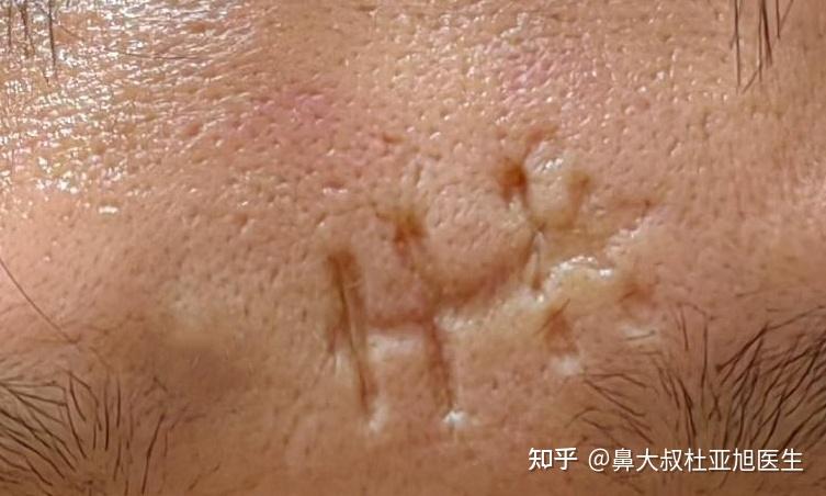 不拆手术线会对伤口造成哪些伤害？ - 知乎