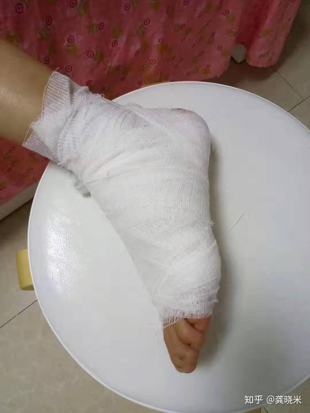 脚踝扭伤用什么最有效?