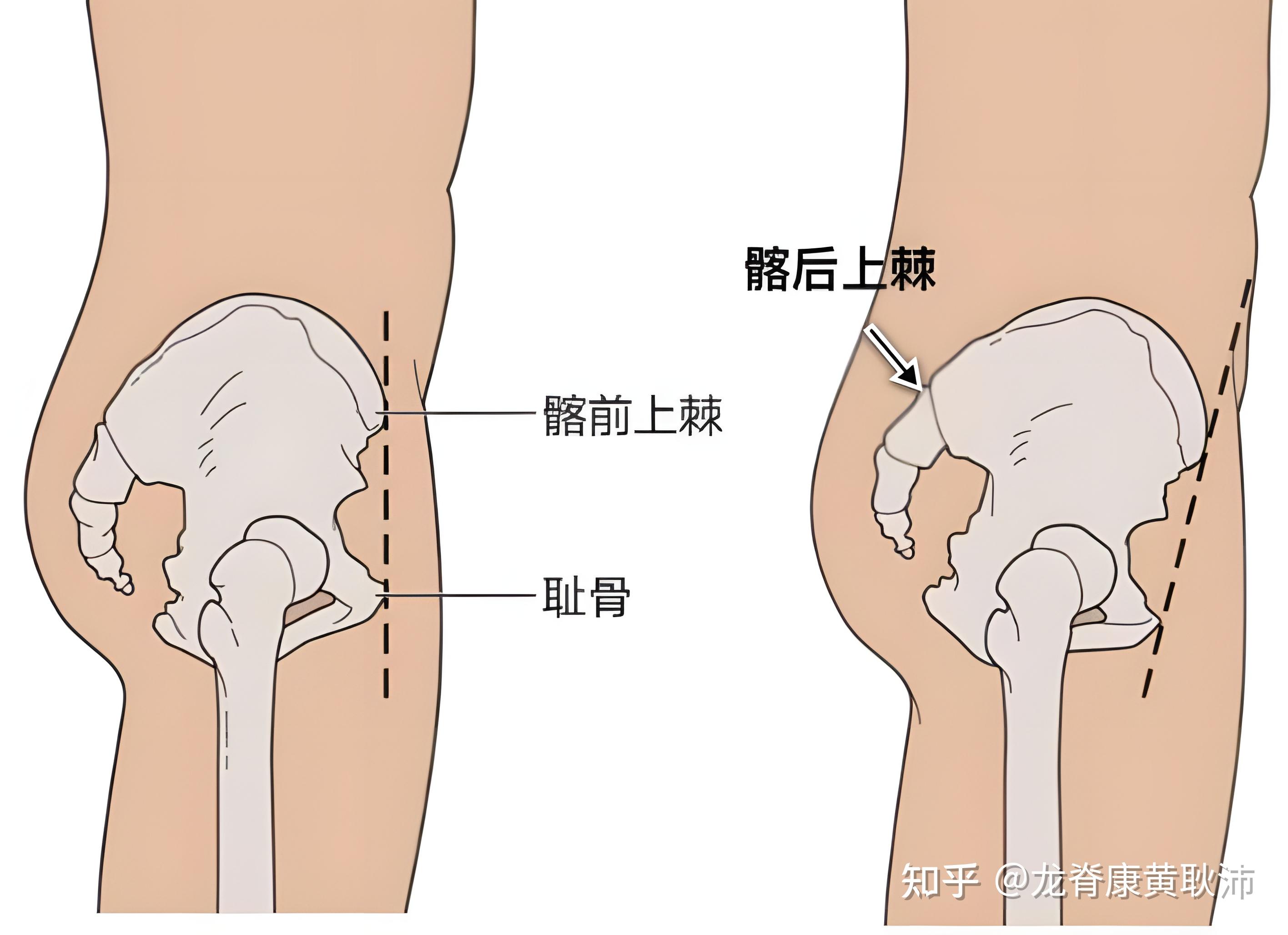 盆骨前倾照片图片