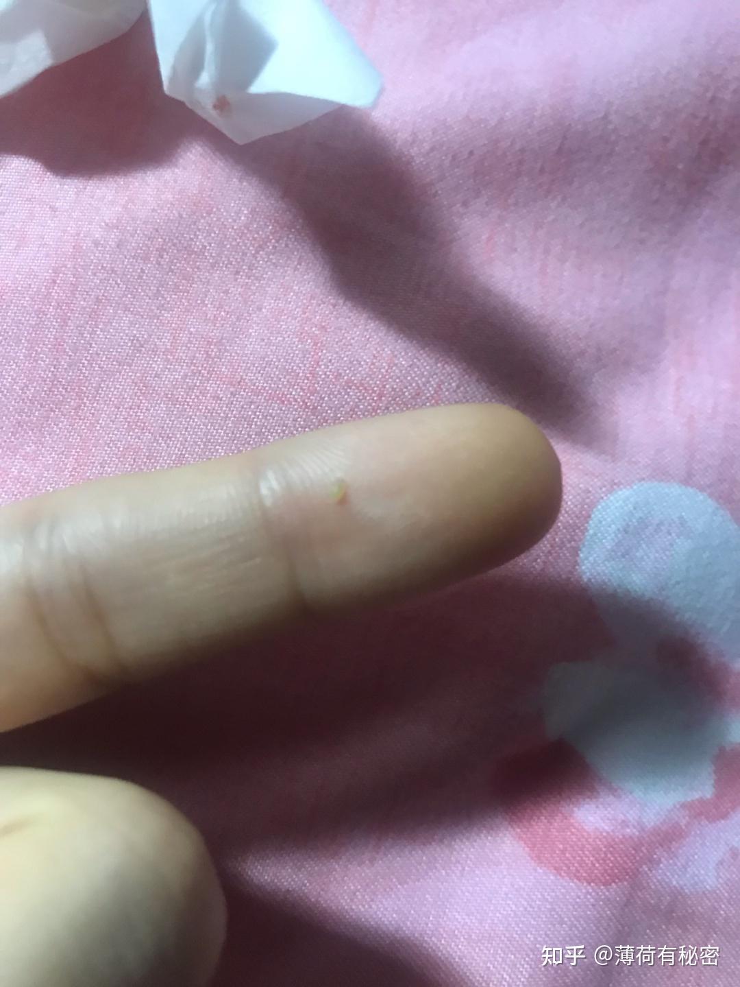 请问痘痘里面挤出来的黄黄的小颗粒是什么东西啊 怎么可以去除?