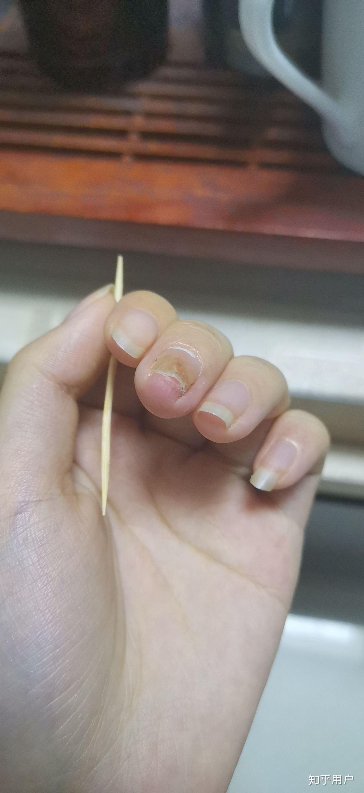 甲分离有六七年了从一个指甲慢慢发现到6个并且脚趾甲也开始空了每年4