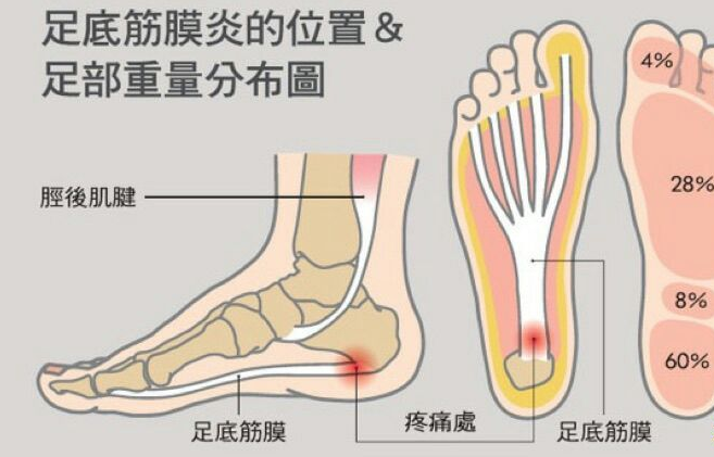 足底筋膜炎难消除？专家说：只要用对方法，治愈足底筋膜炎省钱又高效 