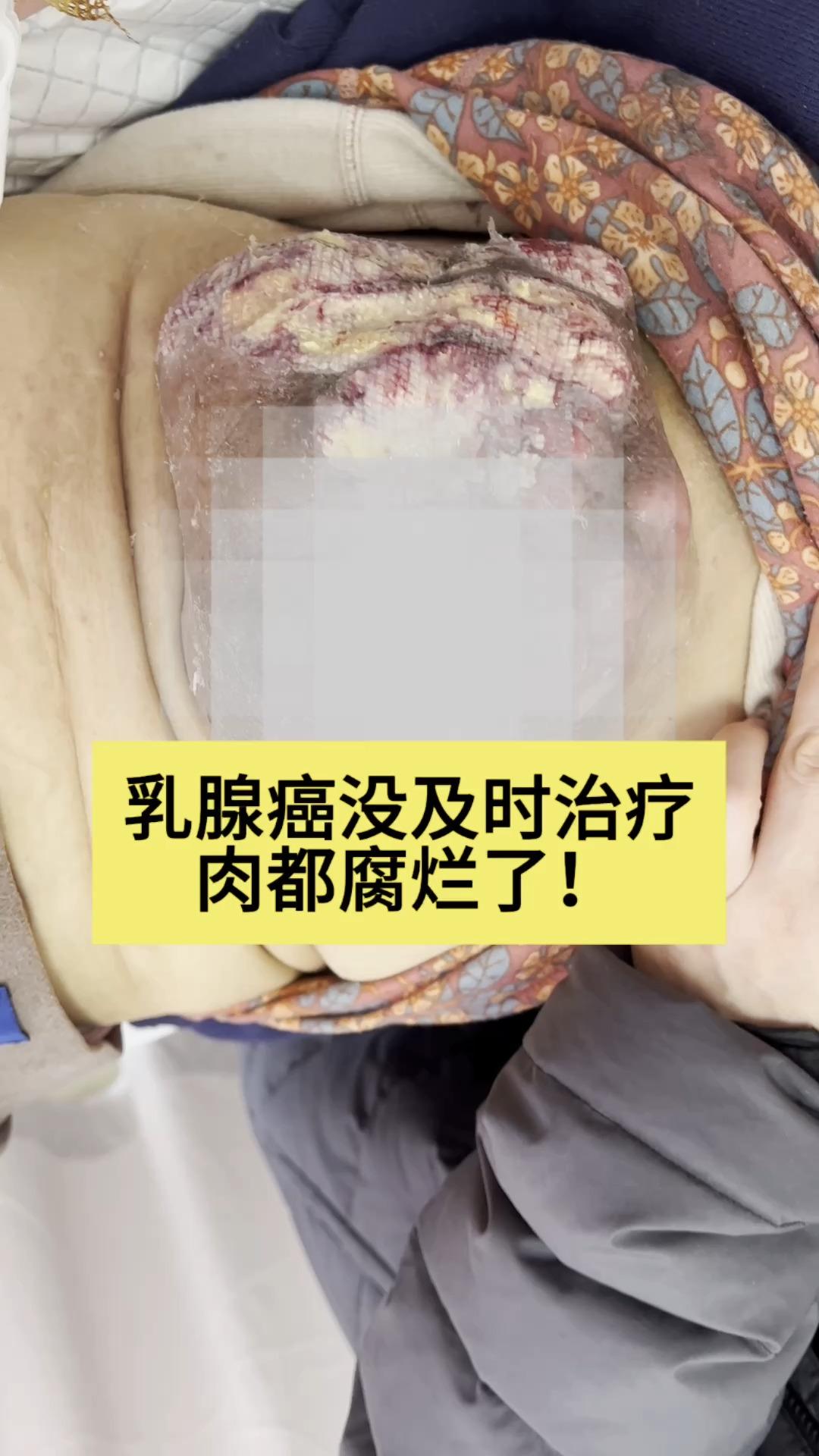 整个乳腺被癌细胞占据,变成篮球那么大,而且已经腐烂发臭了