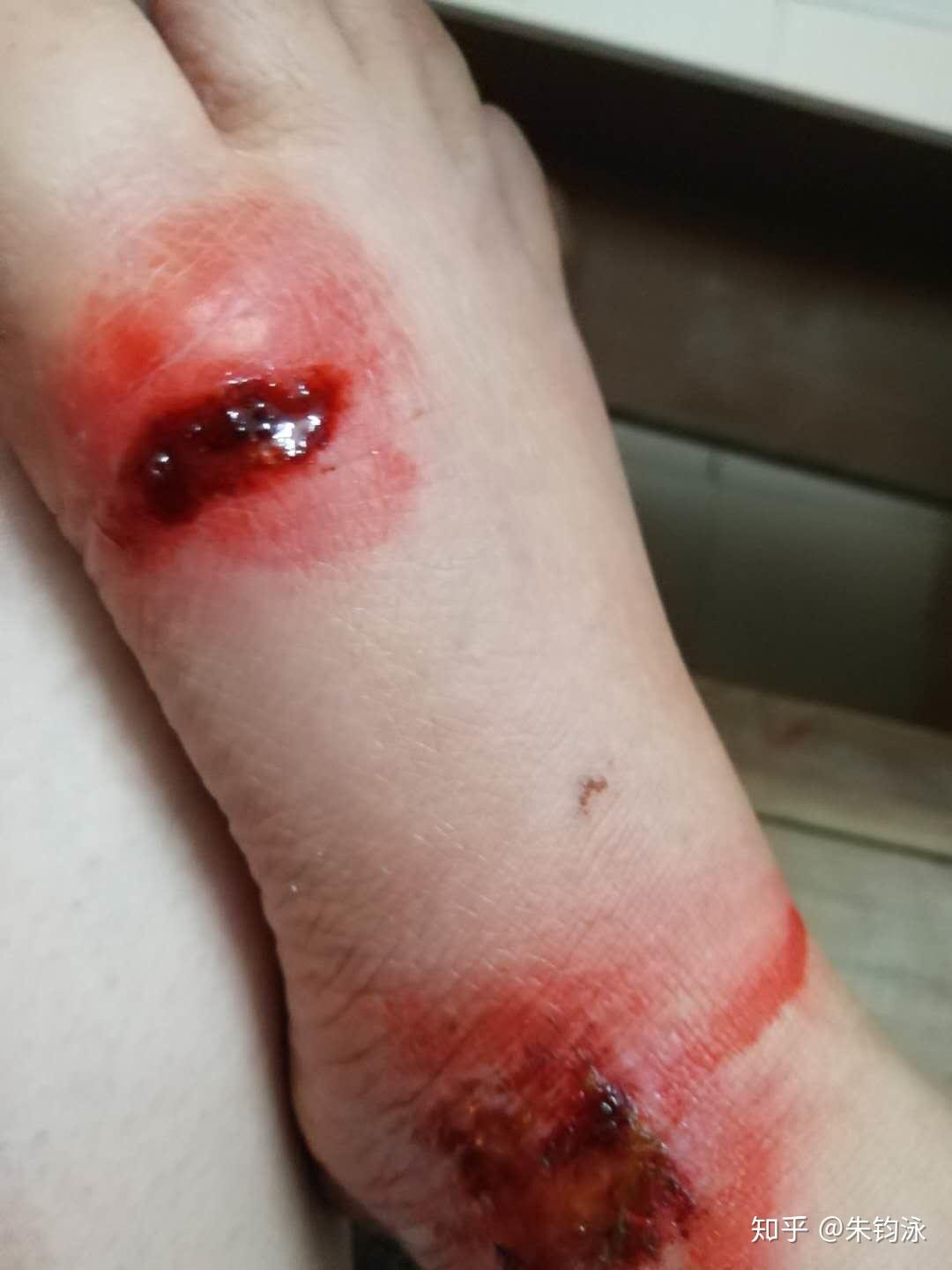 怎样处理伤口以后能不留疤痕? - 知乎