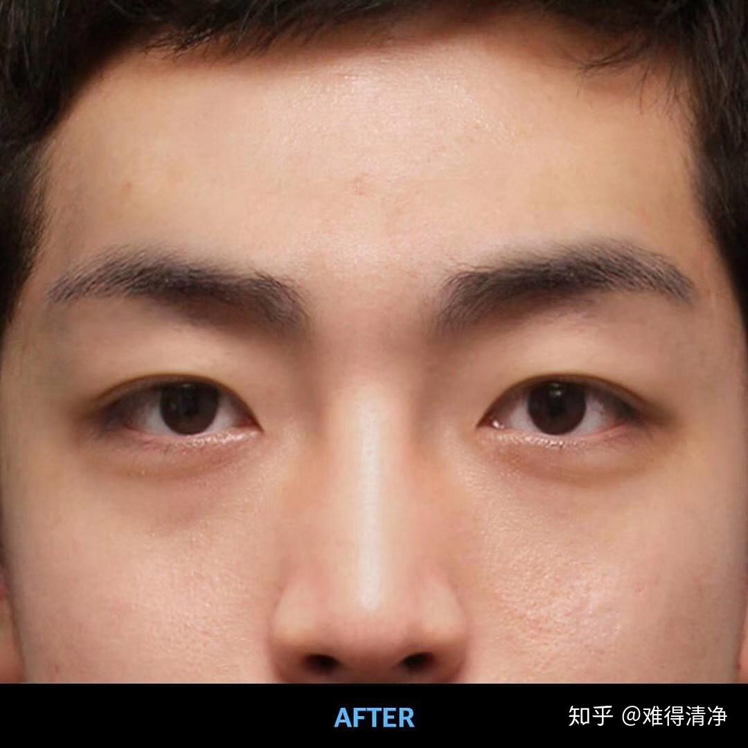 男生可以割双眼皮吗