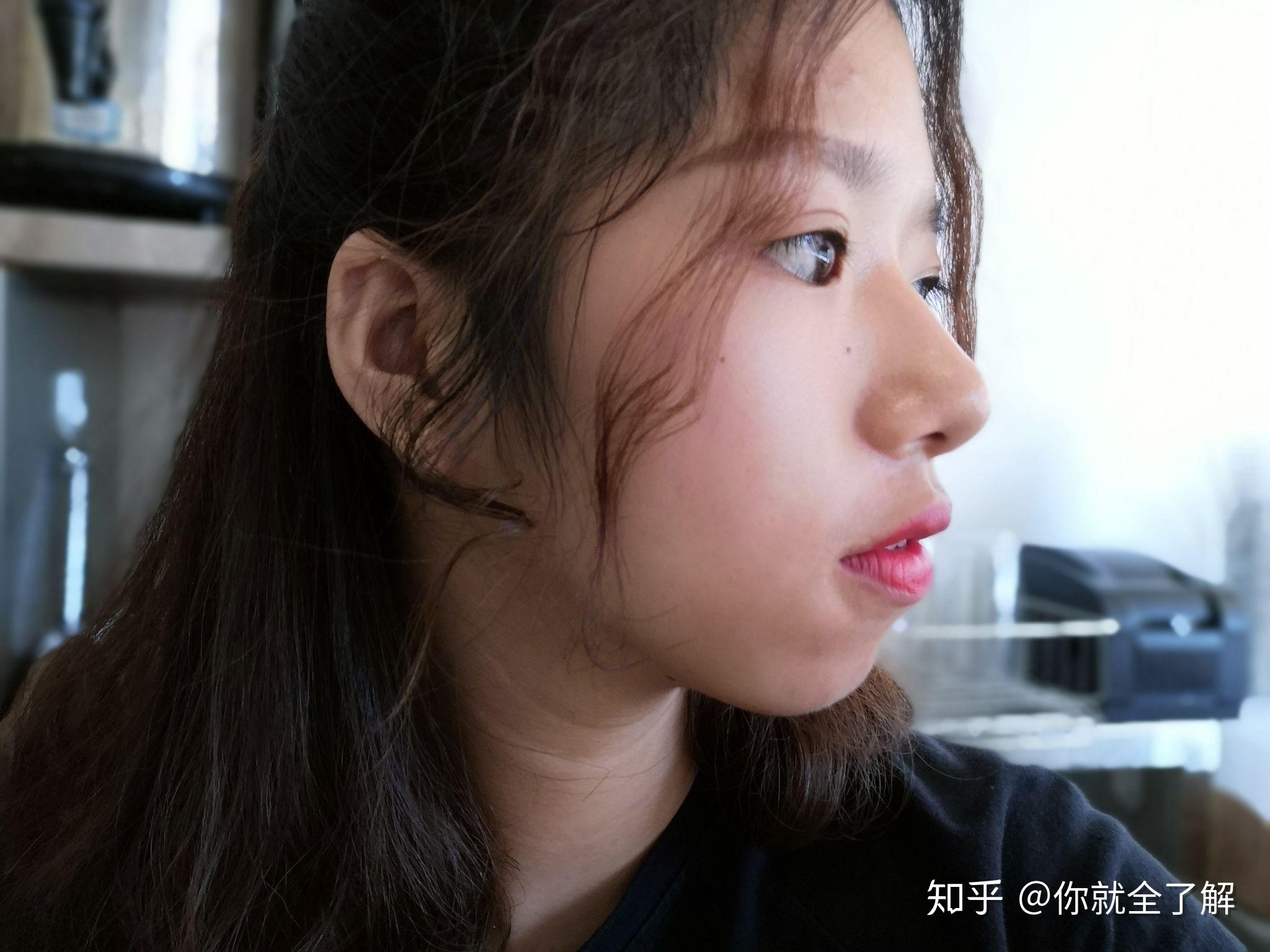 女生凸嘴如何通过化妆或整形及其他方式改变