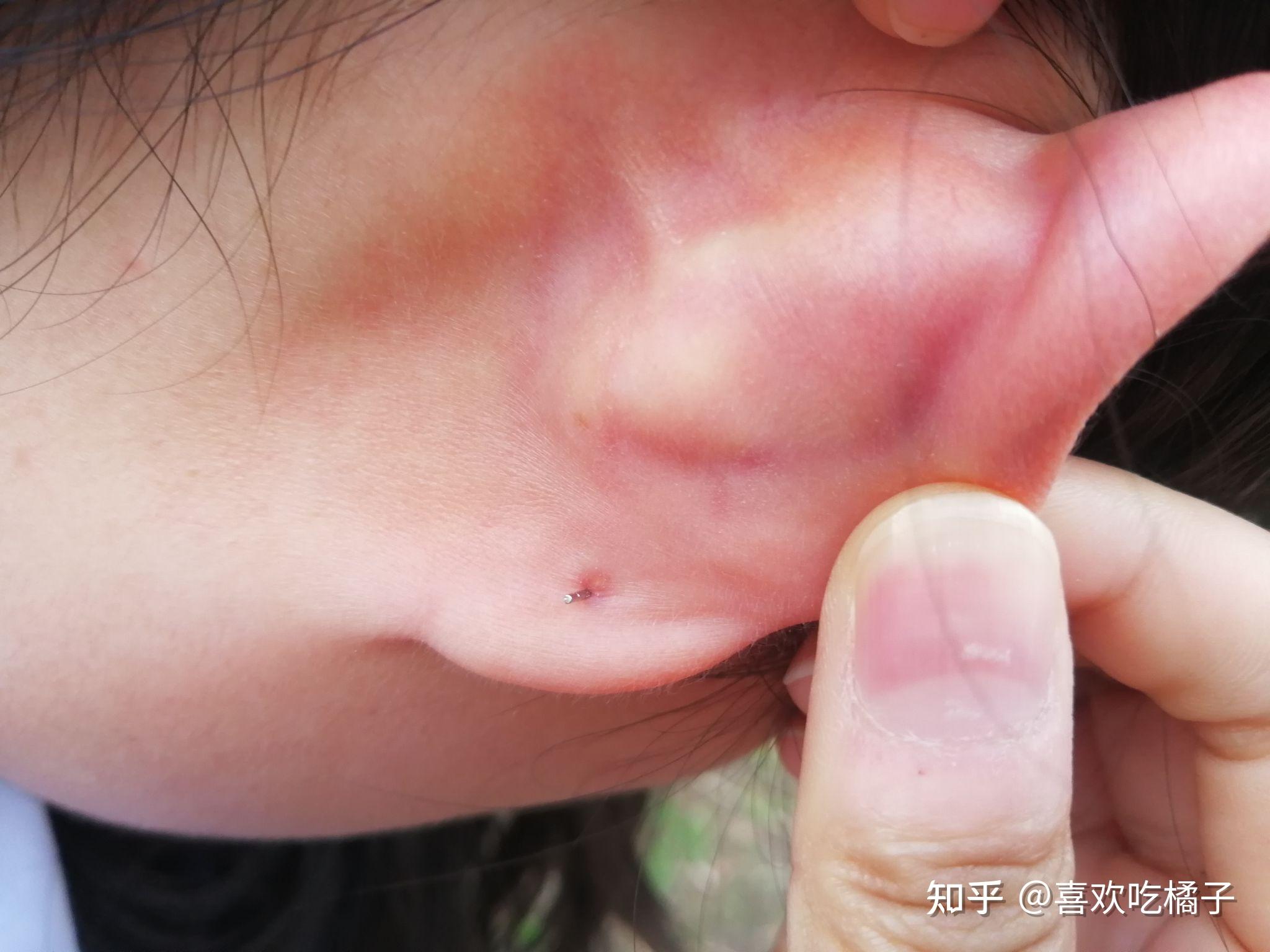 打耳洞一年了,耳洞周围一圈发红但是不疼不痒,一换耳钉耳洞里面就变红