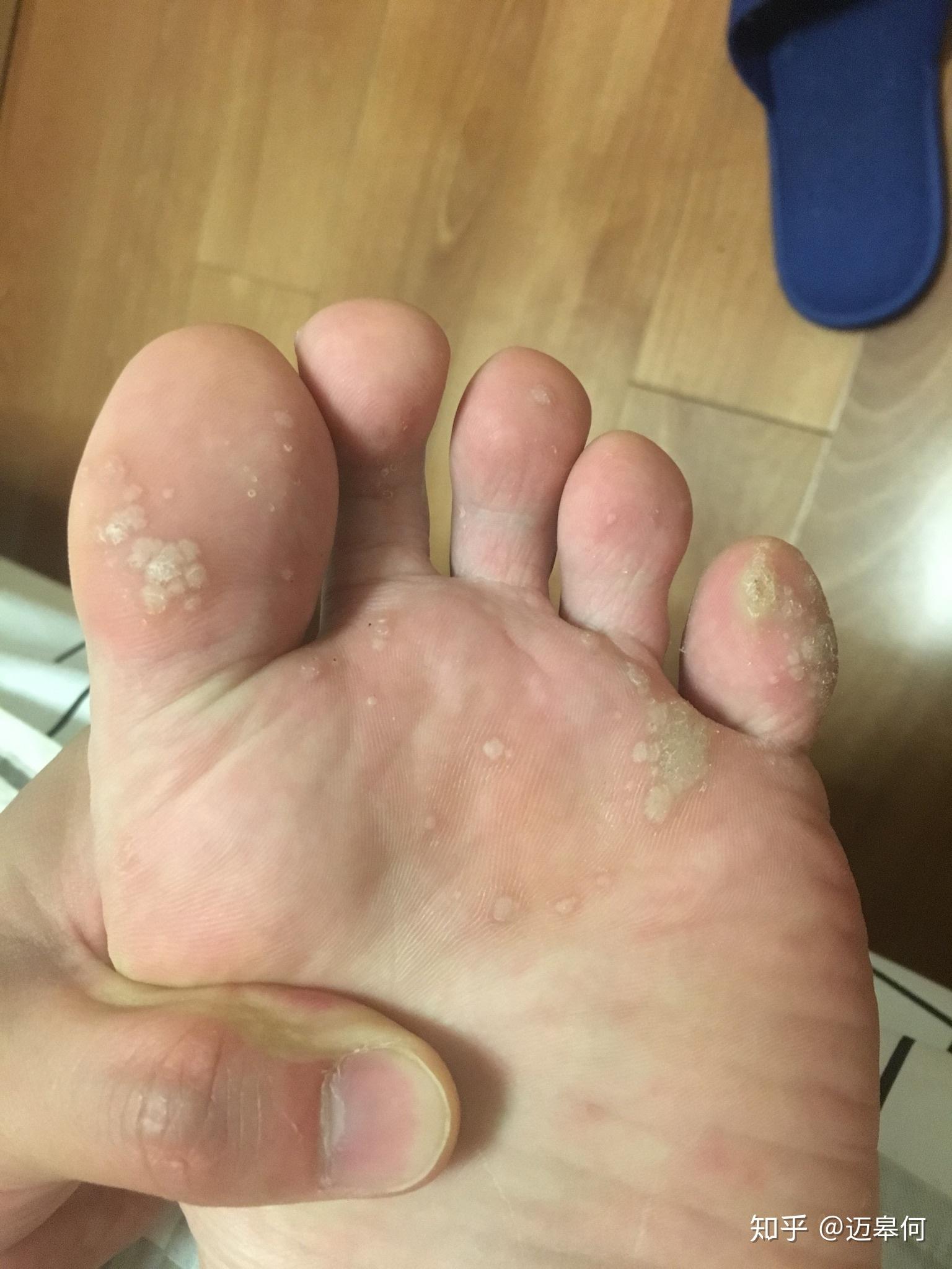 脚底长跖疣怎么办