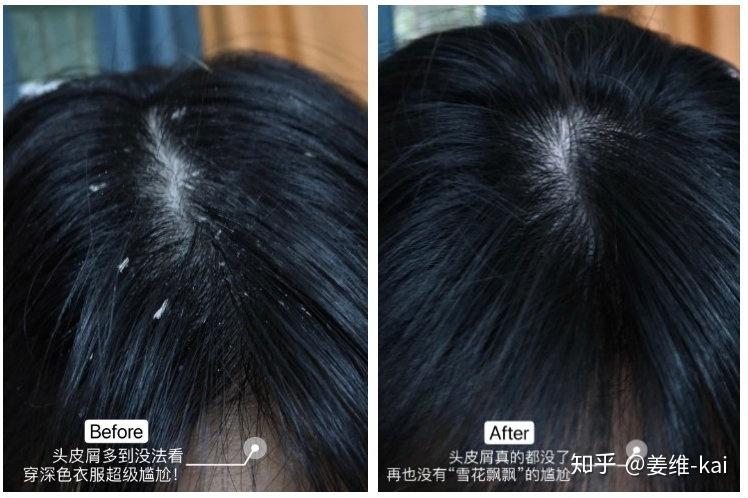 去头屑用什么牌子的洗发水比较好