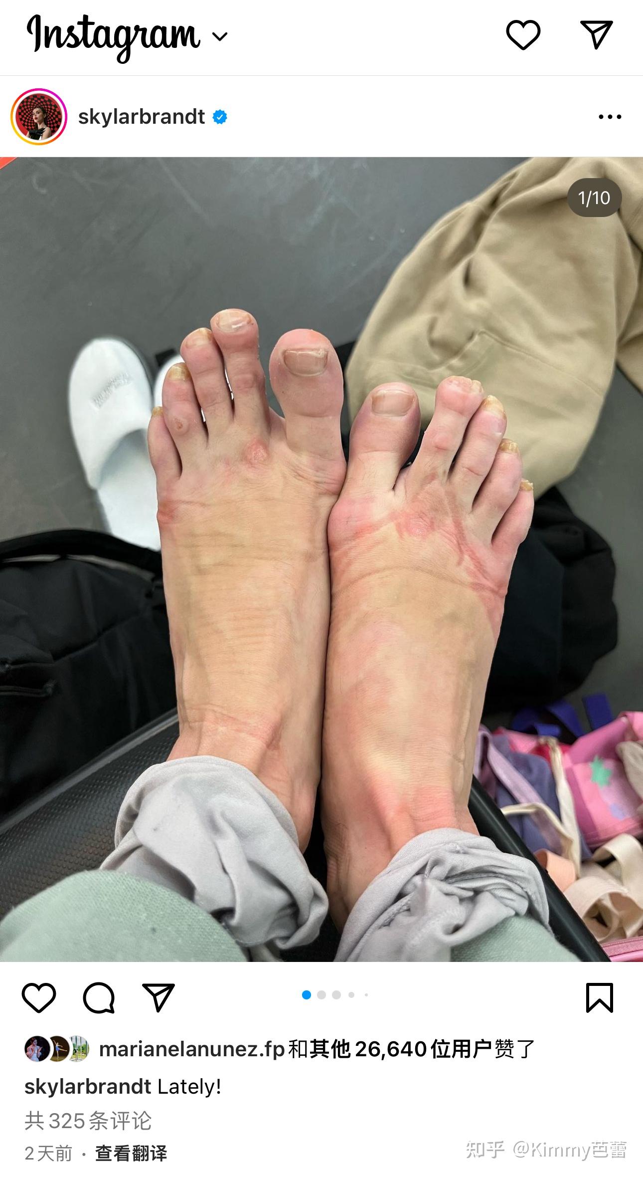 芭蕾舞演员的脚会变成什么样?