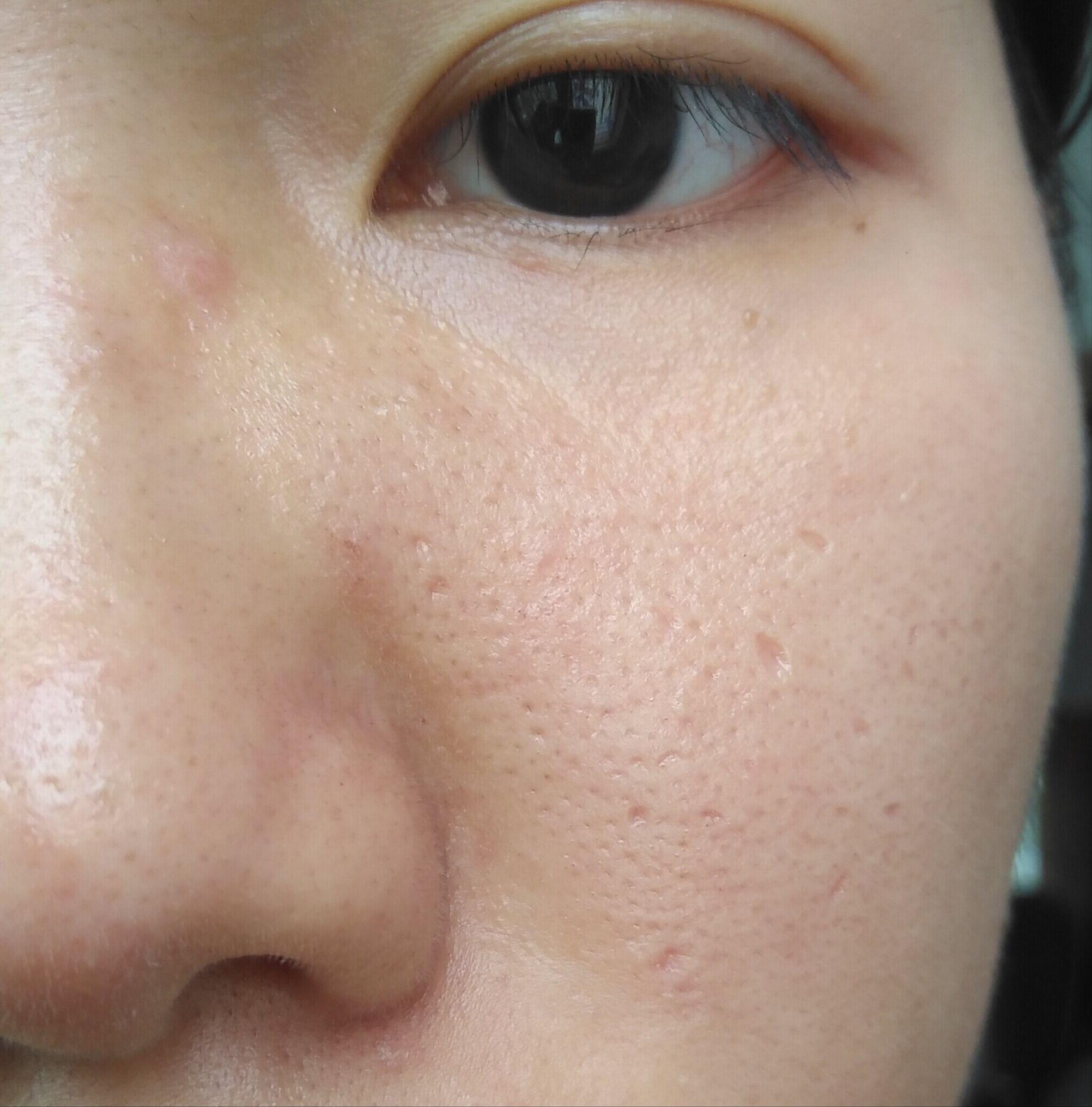 17岁女生,因为脸上的痘坑对生活失去了信心? - 知乎