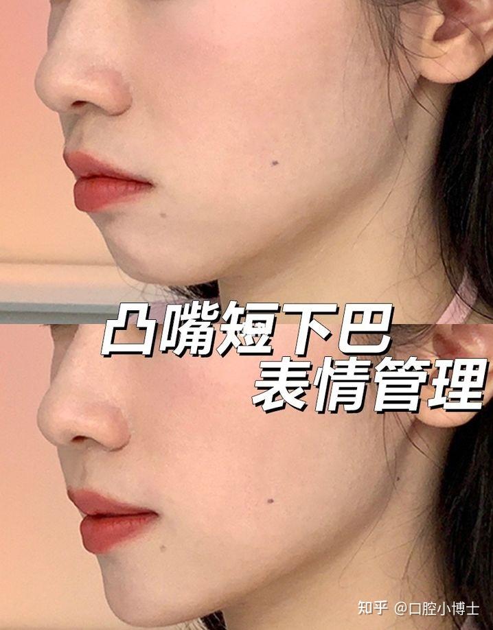 嘴巴凸应该怎么办啊啊啊