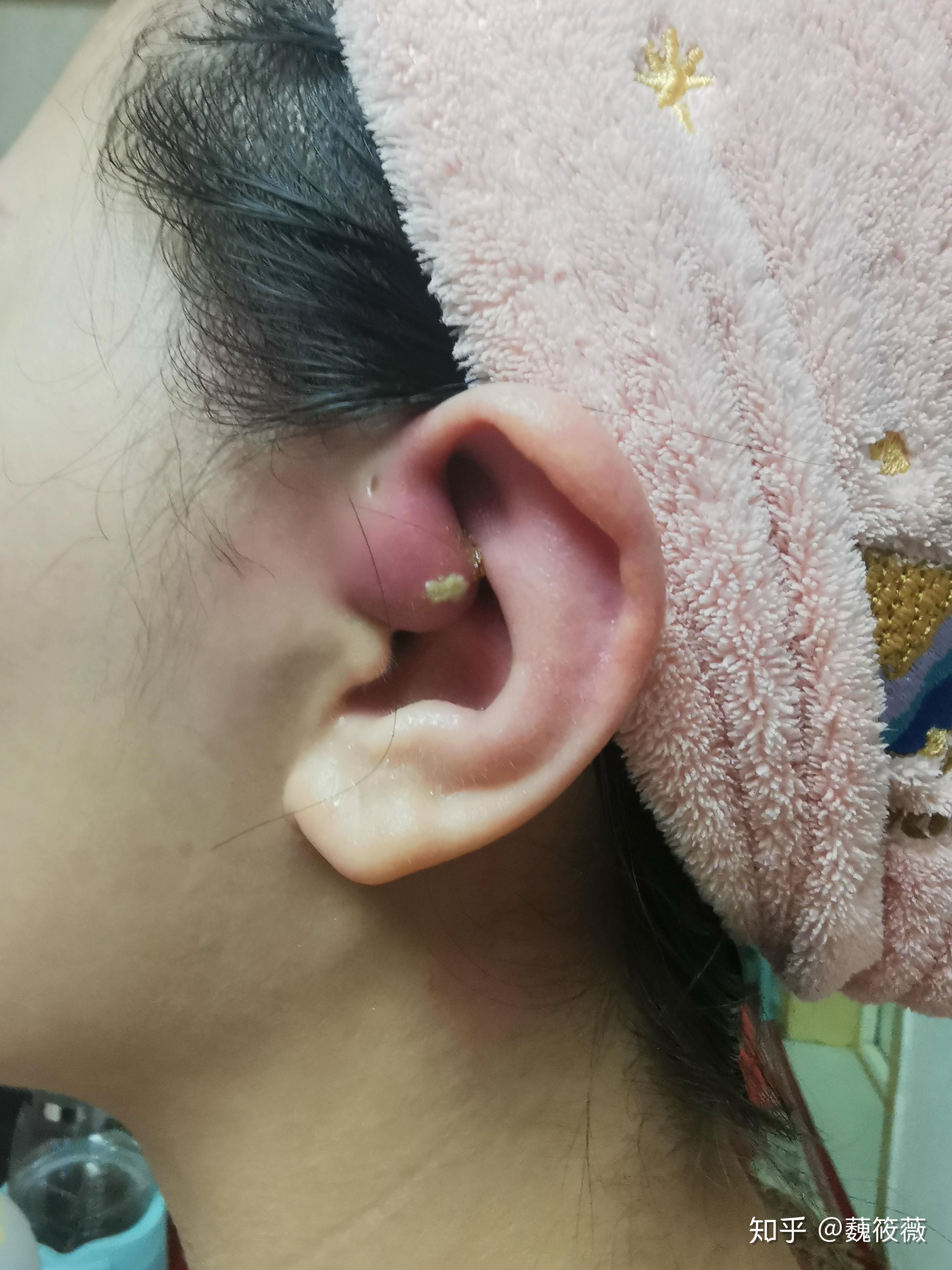 患有先天性耳前瘘管是一种怎样的体验