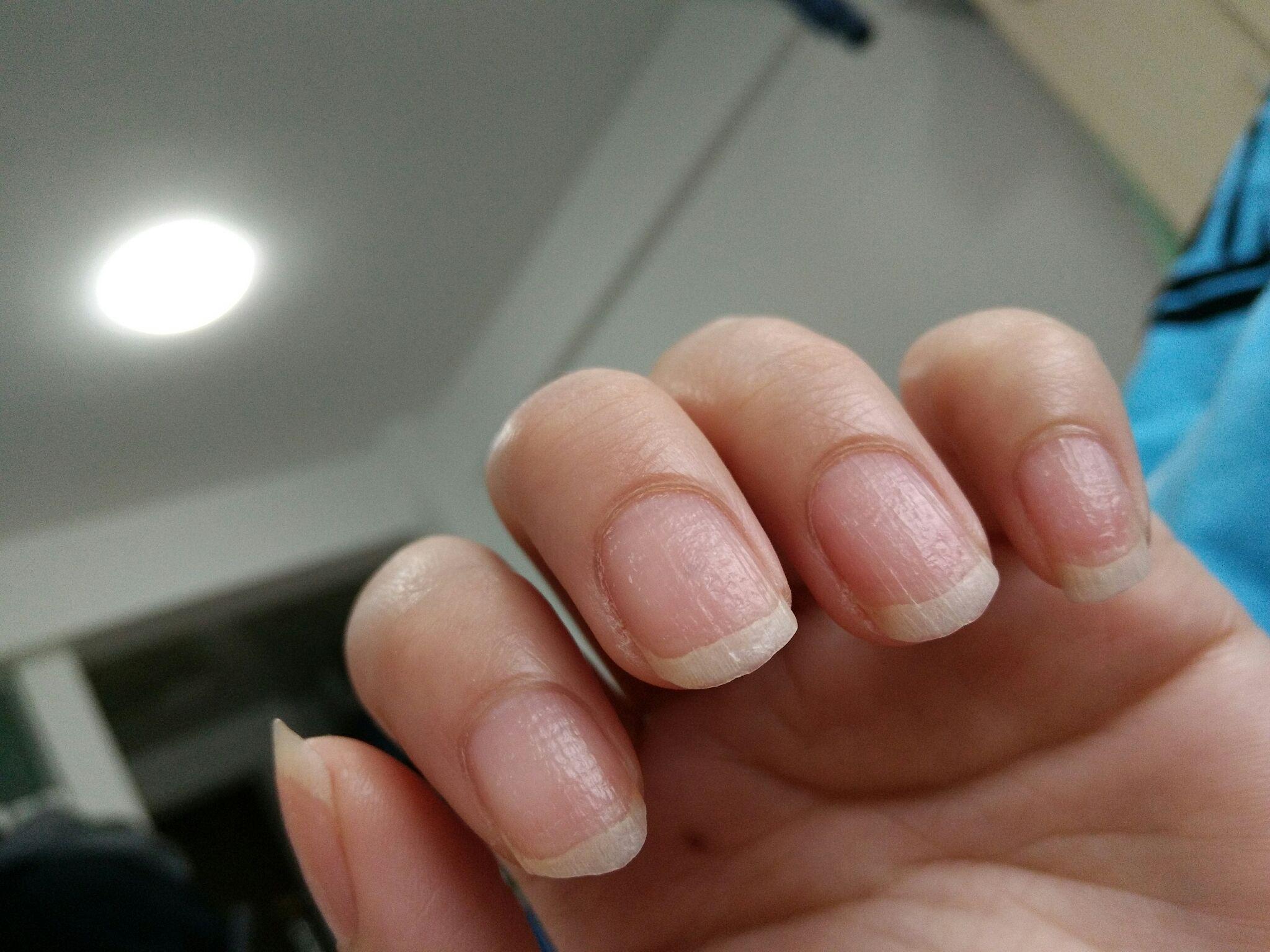 指甲有竖纹究竟是什么原因总体颜色有点偏紫色怎么回事