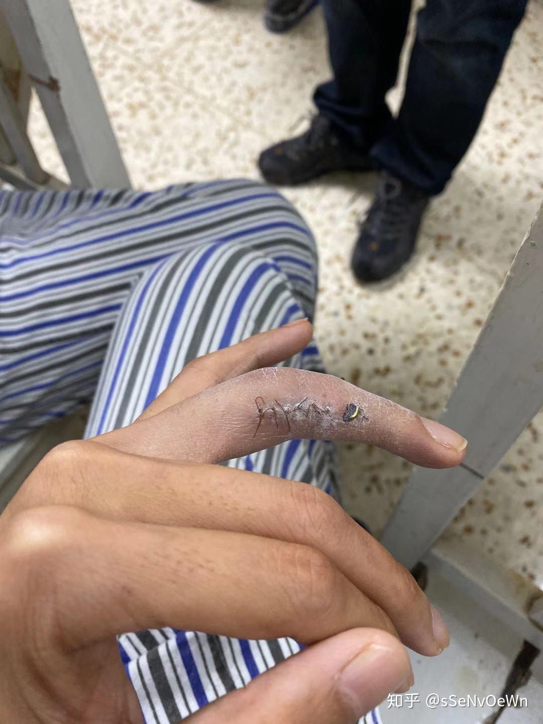 手指头骨折是种怎样的体验? - 知乎