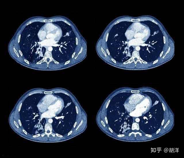 咯血就是肺癌? 其实可能存在多种原因 - 知乎