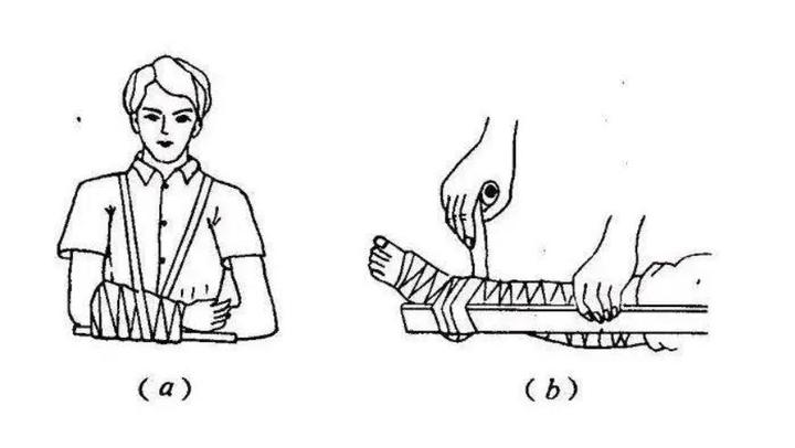 不小心摔伤骨折怎么办石膏固定后该注意什么