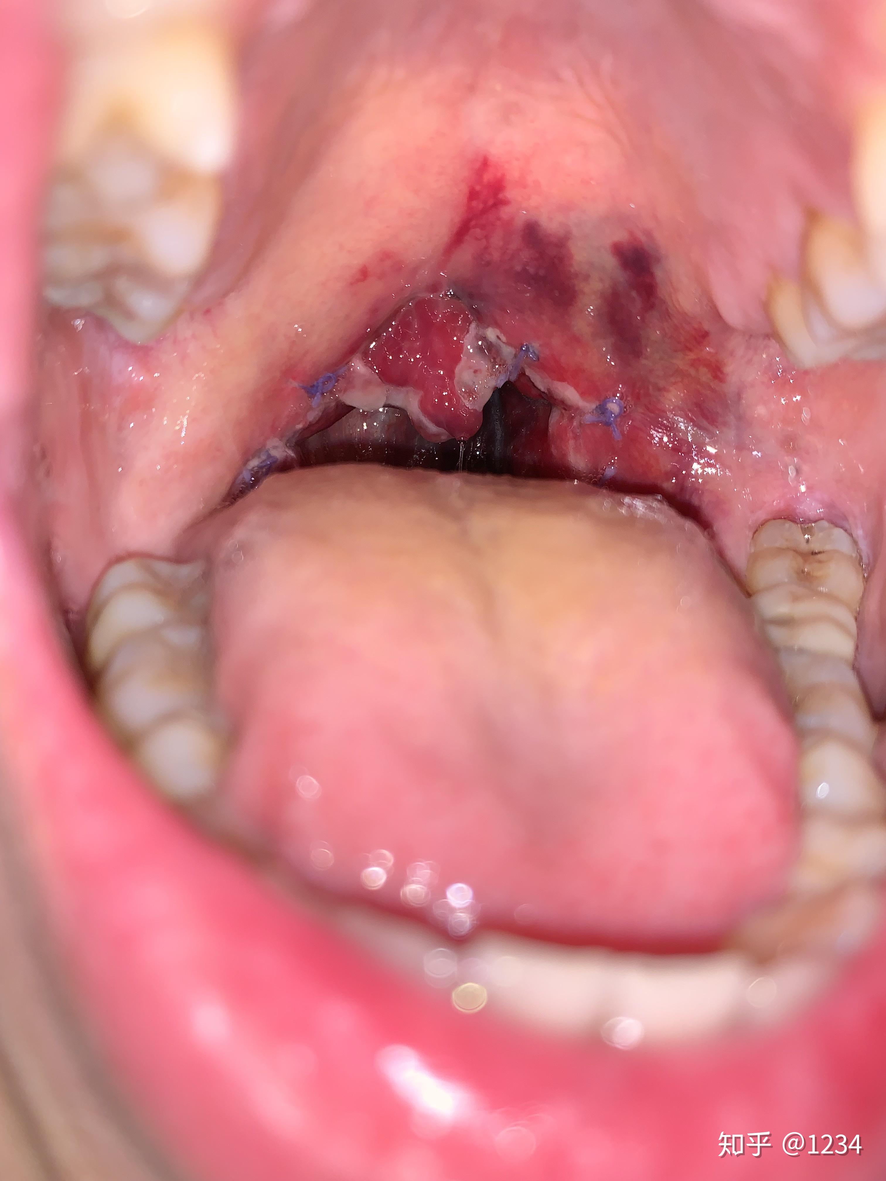 扁桃体切除手术的体验是怎样的? - 知乎