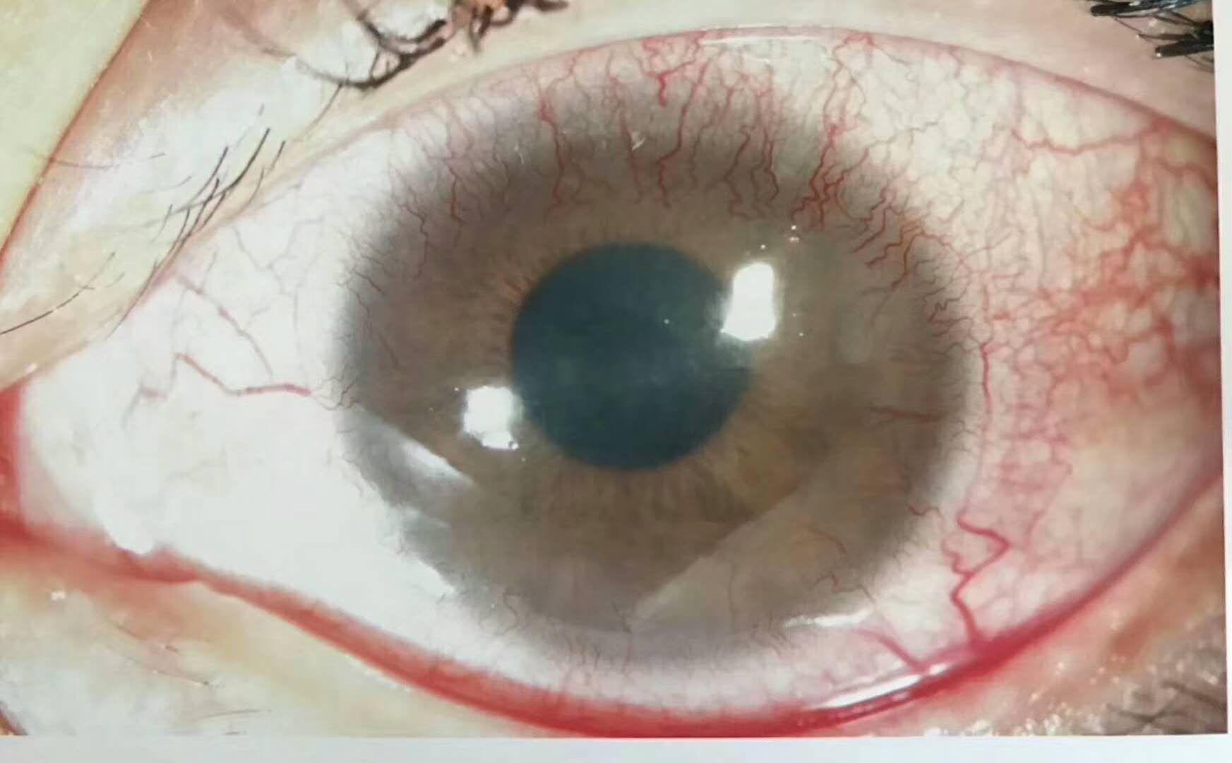 近畿大学医学部眼科教室|眼科の病気|角膜疾患